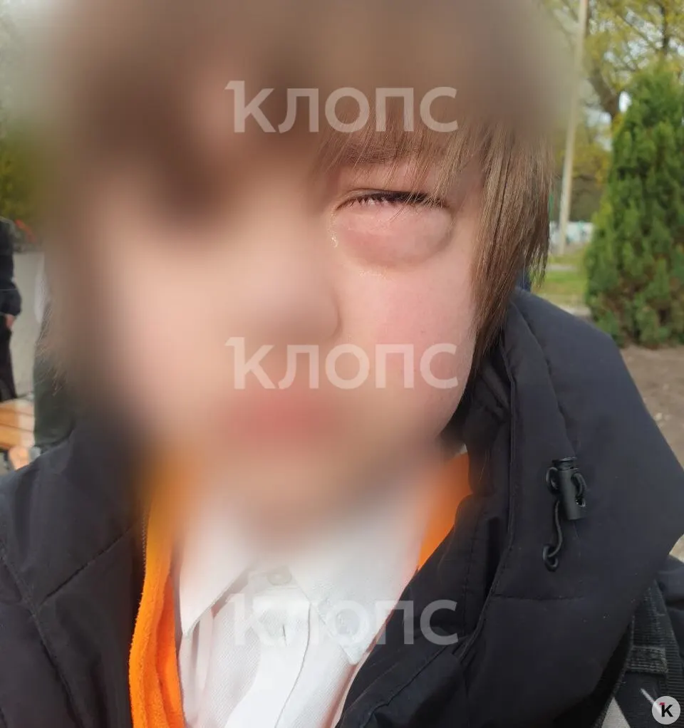 Мальчик получил перелом глазницы и был экстренно госпитализирован после конфликта в классе; мать утверждает, что учитель не вмешивался.